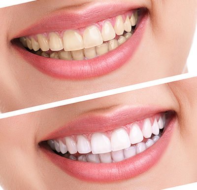 Teeth Whitening Difference After treatment